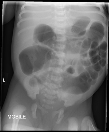 Hirschsprung | Radiology Case | Radiopaedia.org