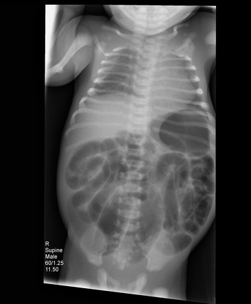 Hirschsprung disease | Radiology Case | Radiopaedia.org