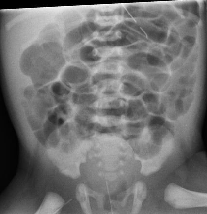 Perforated necrotizing enterocolitis | Radiology Case | Radiopaedia.org