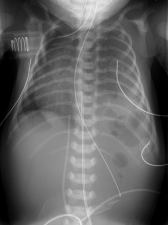 Congenital Diaphragmatic Hernia 