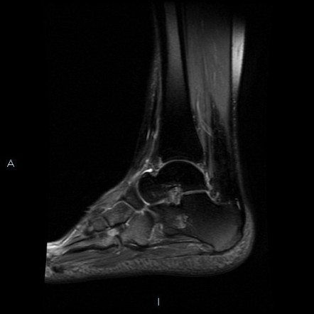 Ankle ganglion cyst | Image | Radiopaedia.org