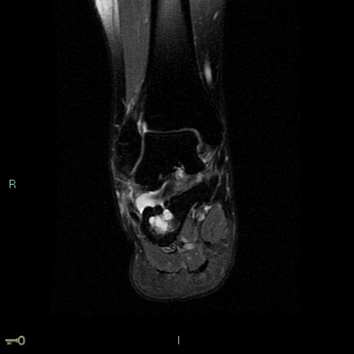 Ankle Ganglion Cyst Image