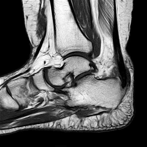 Haglund syndrome | Image | Radiopaedia.org