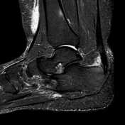 Haglund Syndrome Radiology Reference Article Radiopaedia Org