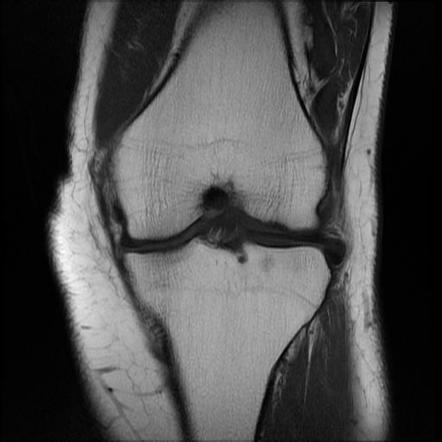 Pigmented villonodular synovitis - knee | Image | Radiopaedia.org