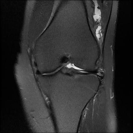 Pigmented villonodular synovitis - knee | Image | Radiopaedia.org