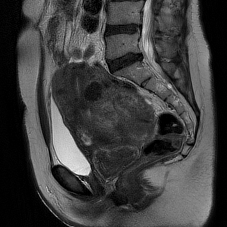 Uterine leiomyomas | Image | Radiopaedia.org