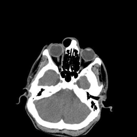 Internal angular dermoid cyst | Radiology Case | Radiopaedia.org