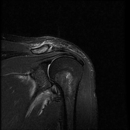 Bankart injury with Hill-Sachs lesion | Image | Radiopaedia.org