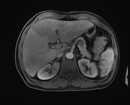 Hepatic abscess | Image | Radiopaedia.org