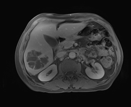 Hepatic abscess | Image | Radiopaedia.org