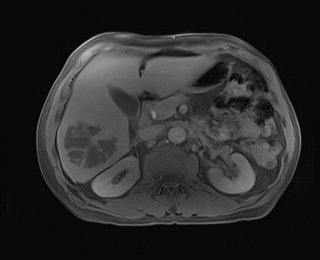 Hepatic abscess | Image | Radiopaedia.org