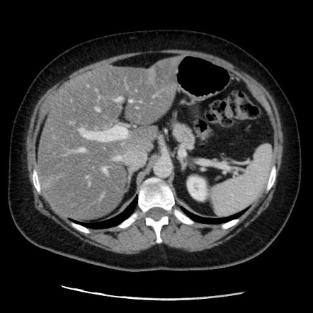 Focal fatty sparing of the liver | Radiology Case | Radiopaedia.org