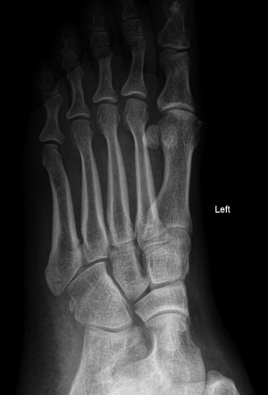 Avulsion fracture of the 5th metatarsal styloid - pseudo-Jones fracture ...