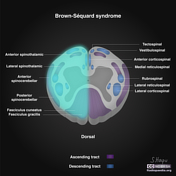 Brown-Séquard syndrome | Radiology Reference Article | Radiopaedia.org