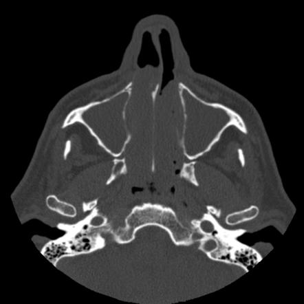 Sinonasal polyposis | Radiology Case | Radiopaedia.org