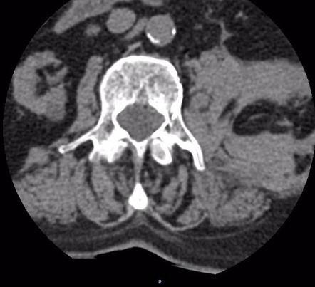 Iliopsoas hematoma - atraumatic | Radiology Case | Radiopaedia.org