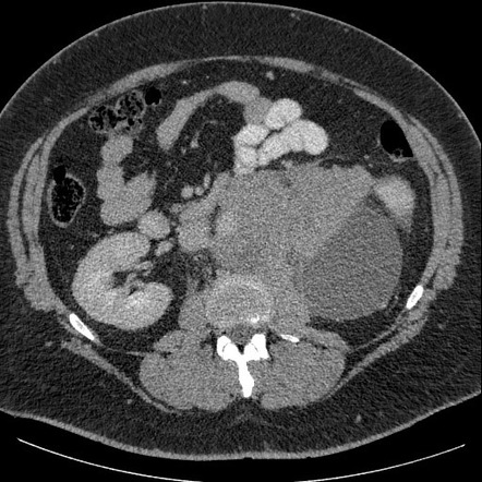 Burned-out testis tumour | Radiology Reference Article | Radiopaedia.org