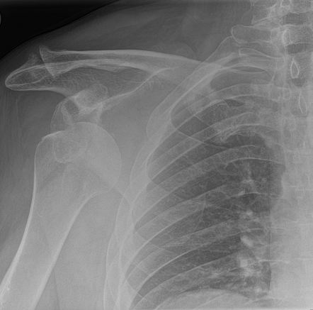 Anterior shoulder dislocation | Radiology Reference Article ...