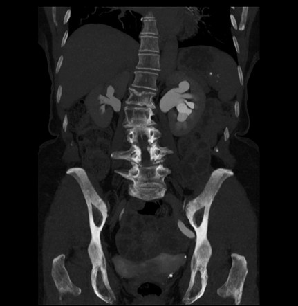 Herniation Of Ureter Into Greater Sciatic Foramen Image Radiopaedia Org