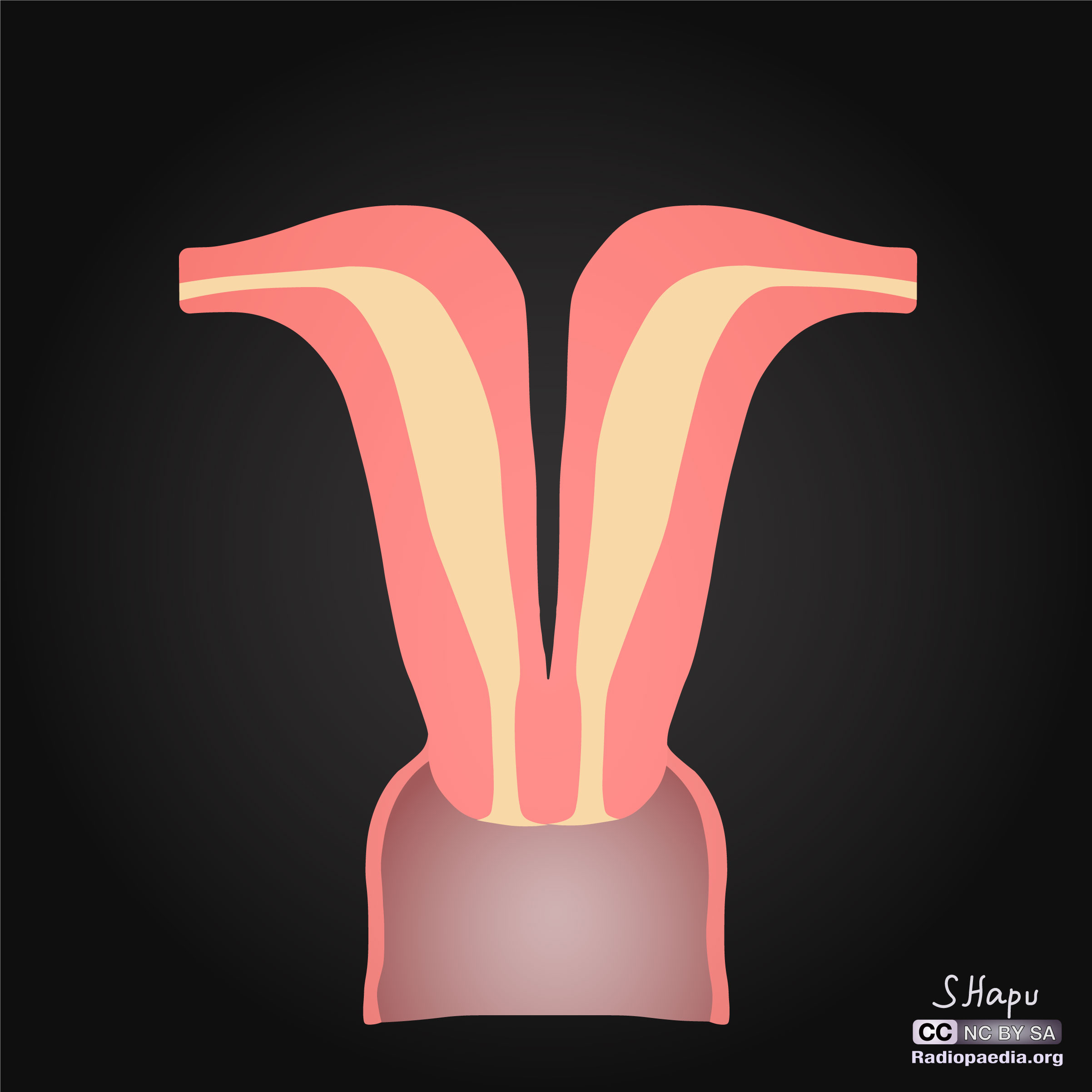 Uterus Didelphys Porn