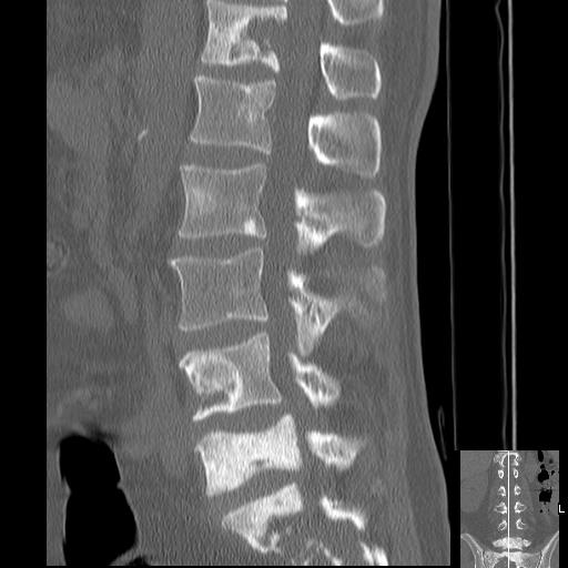 Skeletal metastases - breast cancer | Image | Radiopaedia.org