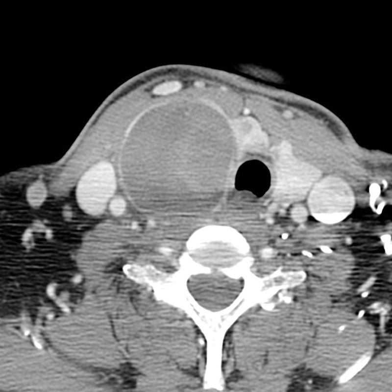 Hemorrhagic thyroid cyst | Image | Radiopaedia.org