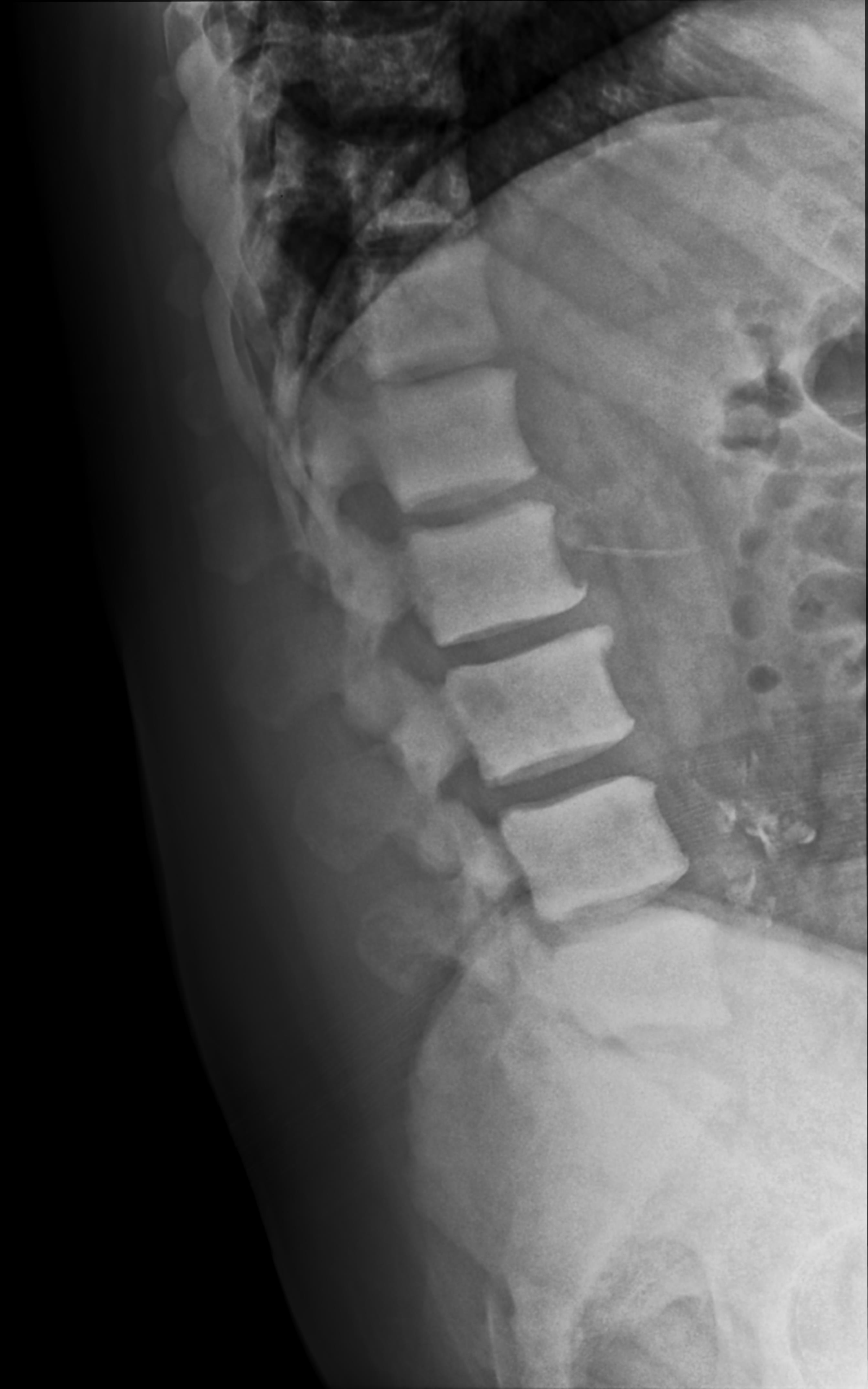 Diffuse bone sclerosis | Image | Radiopaedia.org