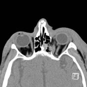 Orbital blowout fracture | Radiology Reference Article | Radiopaedia.org