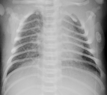 Transient Tachypnea Of The Newborn | Radiology Case | Radiopaedia.org