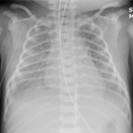 Viewing playlist: Neonatal CXR | Radiopaedia.org