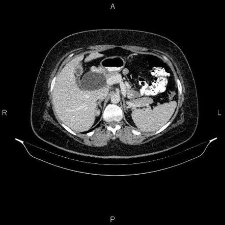 Choledochal cyst - type I | Radiology Reference Article | Radiopaedia.org