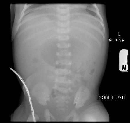 Intestinal Malrotation | Image | Radiopaedia.org