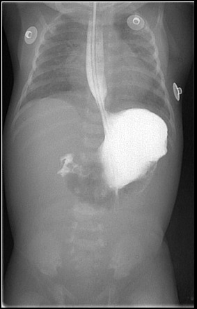 Intestinal Malrotation | Image | Radiopaedia.org