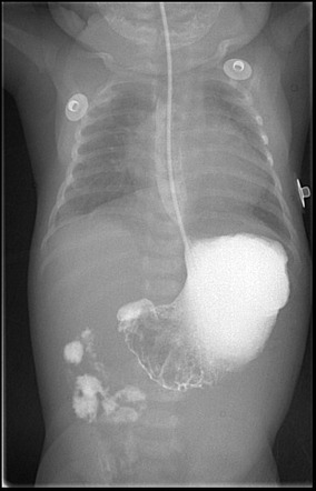 Intestinal malrotation | Radiology Case | Radiopaedia.org