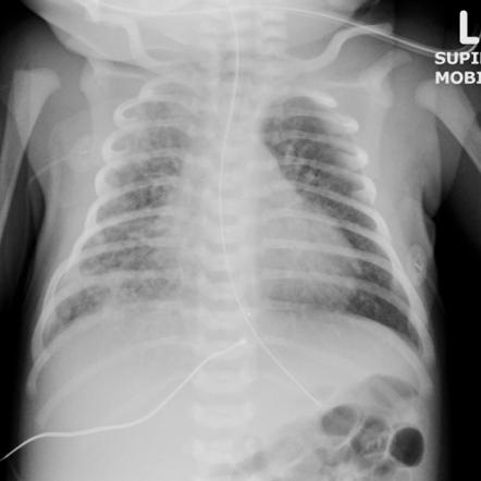 Neonatal Pneumothorax Radiology Reference Article Radiopaedia Org