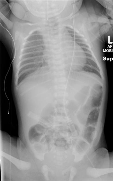 Butterfly vertebra | Radiology Reference Article | Radiopaedia.org