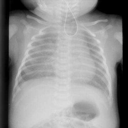 TOF/OA - coiled NG | Radiology Case | Radiopaedia.org