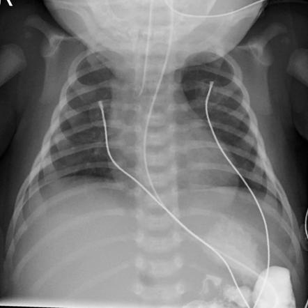 Left clavicular fracture - birth injury | Radiology Case | Radiopaedia.org