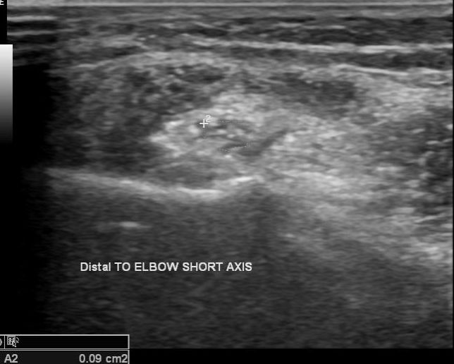 Cubital tunnel syndrome | Image | Radiopaedia.org