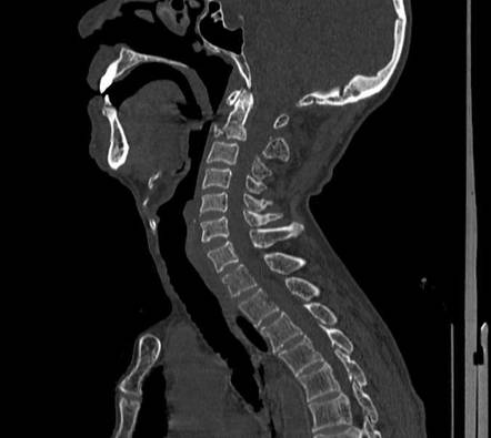 Hyperextension cervical injuries | Radiology Reference Article ...