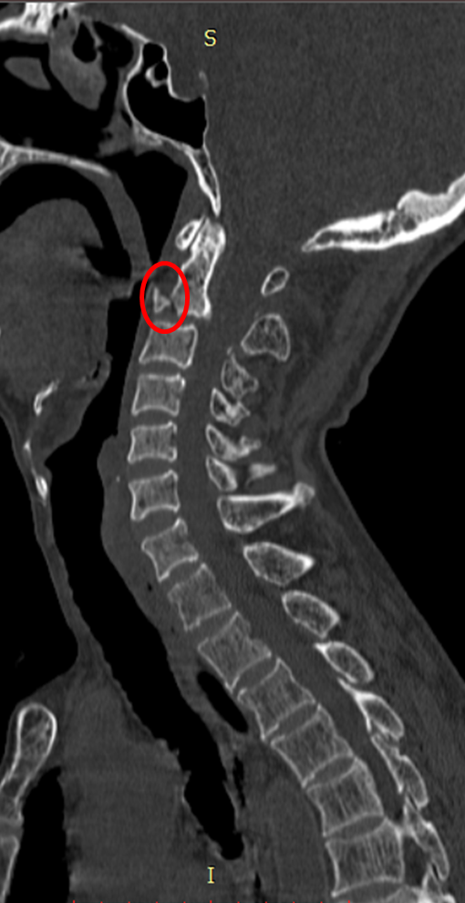 Hyperextension cervical spine injury - Hangman and extension teardrop ...