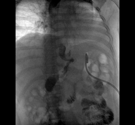 Post sleeve gastrectomy leak with abscess | Image | Radiopaedia.org