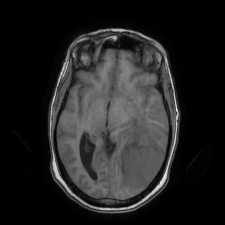 Meningioma Invading The Dural Venous Sinuses Radiology Case