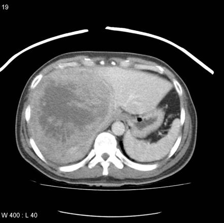 Hepatocellular Carcinoma 