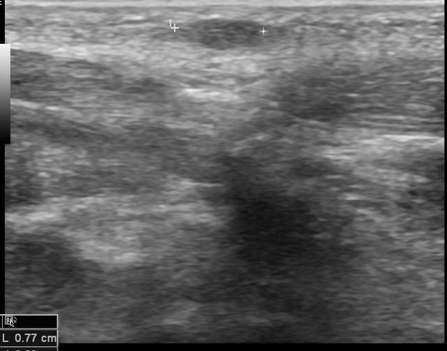 Plantar Fibroma Image Radiopaedia Org