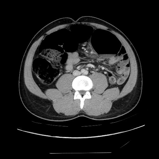 Sigmoid volvulus | Image | Radiopaedia.org