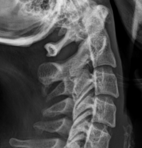 Exostosis | Radiology Reference Article | Radiopaedia.org