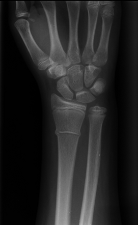 Distal radius buckle fracture | Radiology Case | Radiopaedia.org