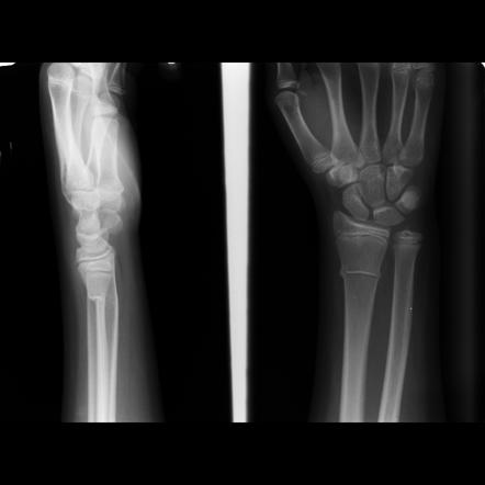 Torus fracture | Radiology Reference Article | Radiopaedia.org